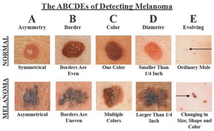 A chart to test your moles to tell if they may or may not be cancerous