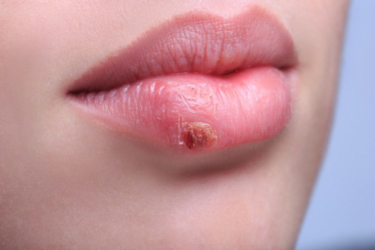 close up. beautiful lips virus infected herpes