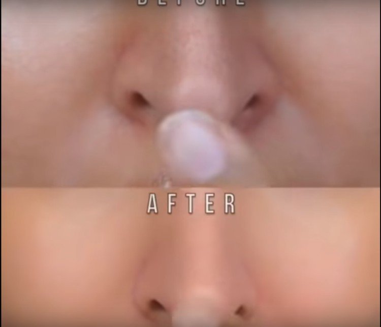 Before and after of Pepto-Bismol mask