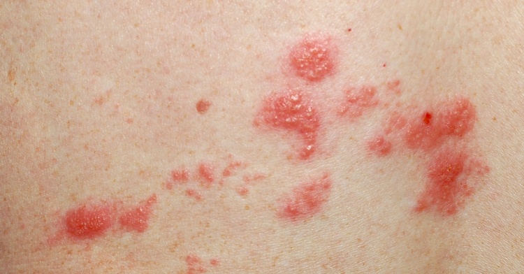 Shingles sores and rash caused by dormant chicken pox virus