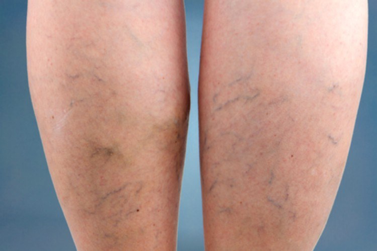 How to treat spider veins at home.