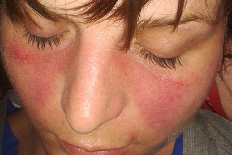 Butterfly or malar rash can be sign of lupus