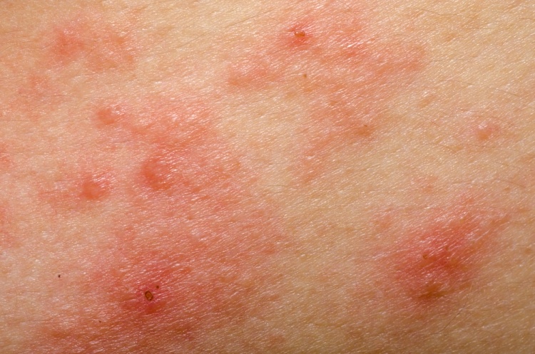 Very dry itchy skin can be a sign of thyroid problem