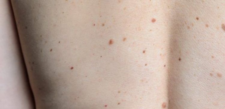 Freckles can be a sign of melanoma