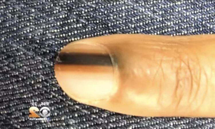 Dark stripe under fingernail.