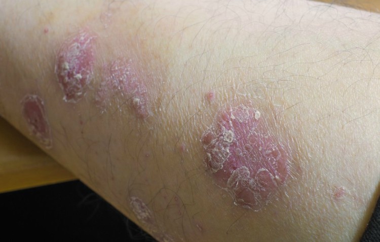 Raised red patches with silver scales are psoriasis
