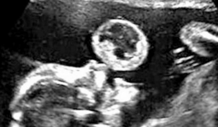 Close up on the tumor in the ultrasound.
