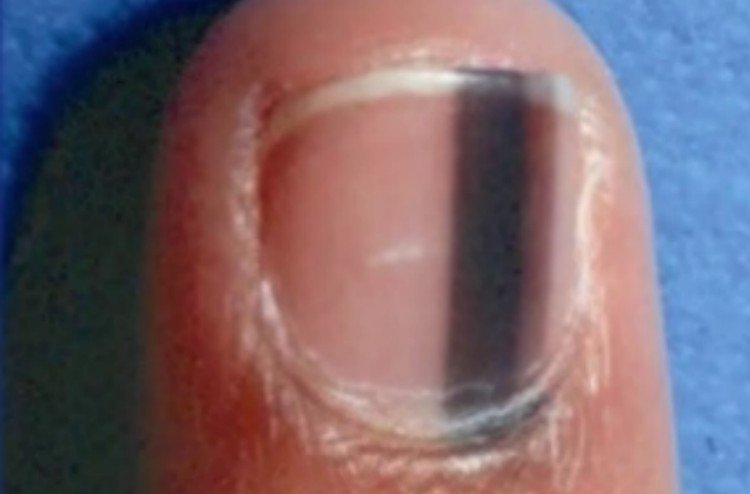 dark band nail