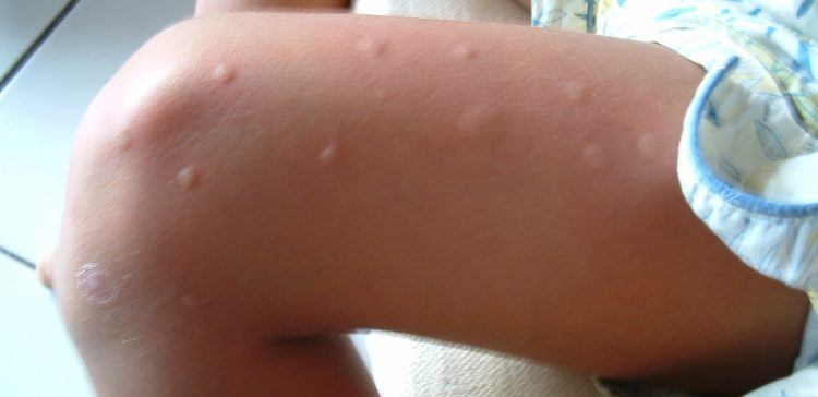 Image of bug bites on leg.