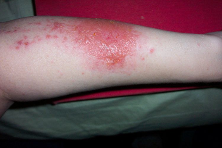 Arm with contact dermatitis rash.