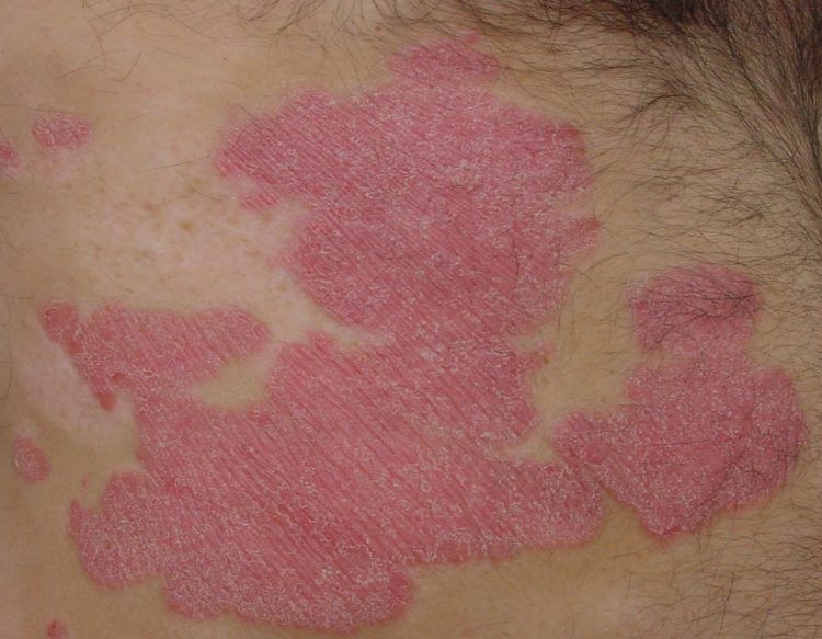 Outbreak of psoriasis.