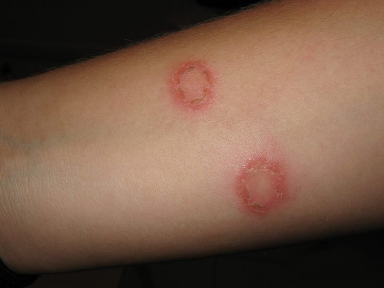 Ringworm on the arm.