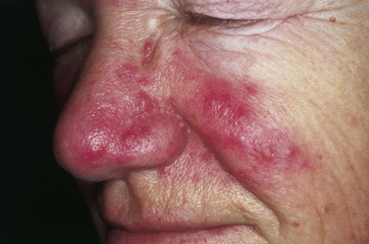 Rosacea on the face.