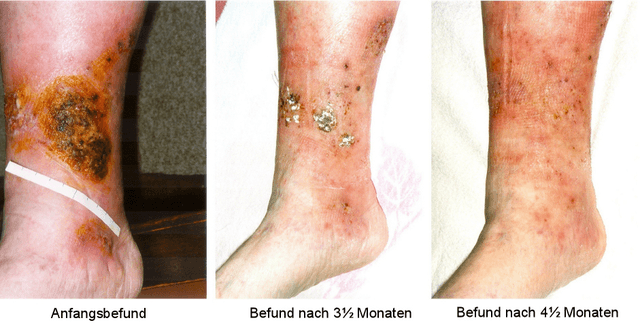 Three cases for stasis dermatitis.