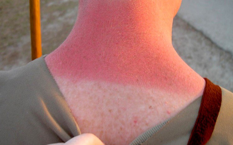 sunburn above neck