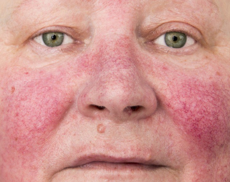 How to treat rosacea at home