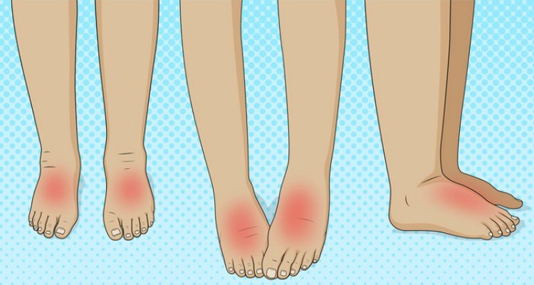 11 Alarming Medical Conditions That Can Make Feet Puff Up