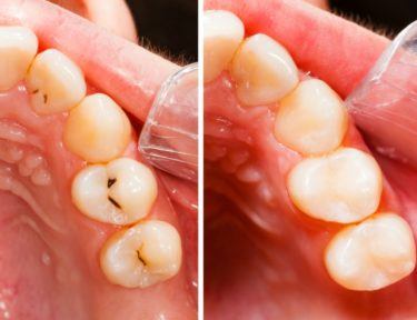 Teeth and cavities