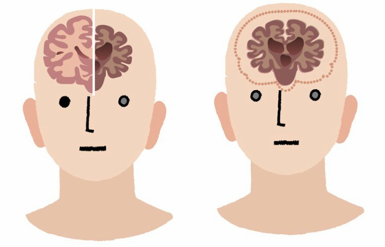 Drawing of person with damaged and healthy brain.