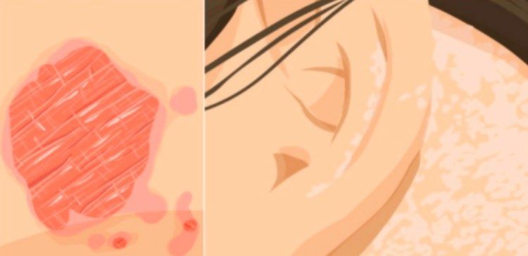 eczema illustrations splitscreen