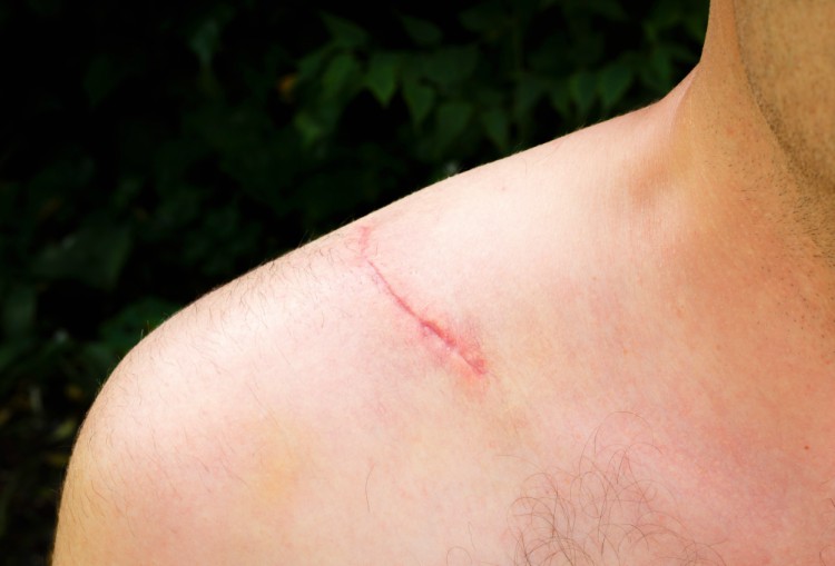 Image of scar on man