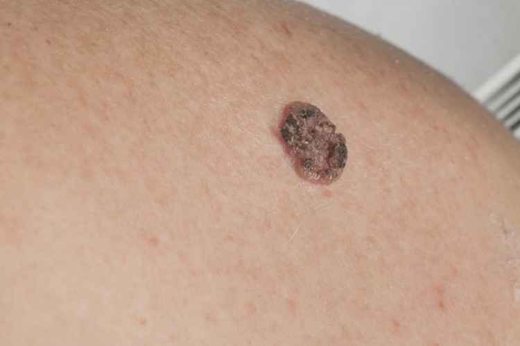 7 Little-Known Causes of Skin Cancer
