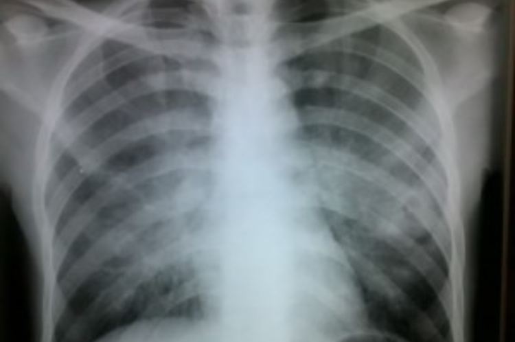 lung cancer chest