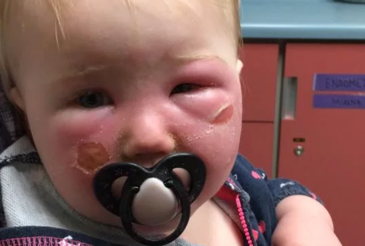 Image of baby with bad burns on cheeks.