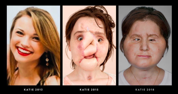 Image of Katie before and after face transplant surgery