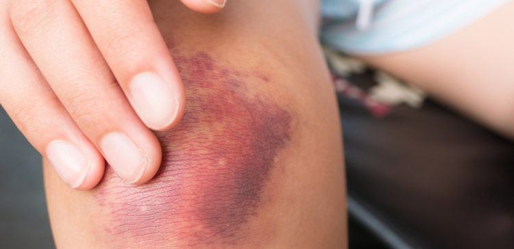 Close up a girl rubs her fingers with a curative ointment in a bruised knee with a bruise