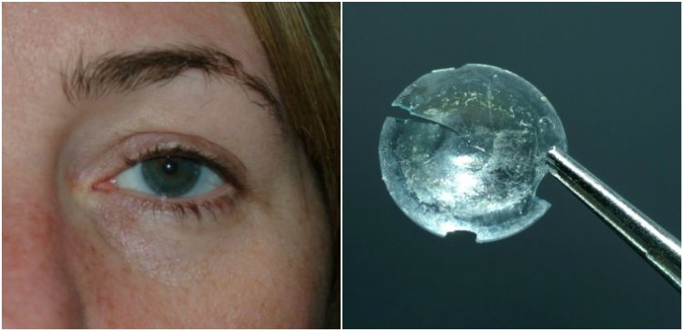 contact lens and woman's eye