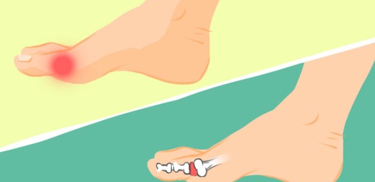 Graphic image indicating gout pain