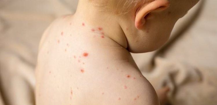 Pic of baby with chicken pox.