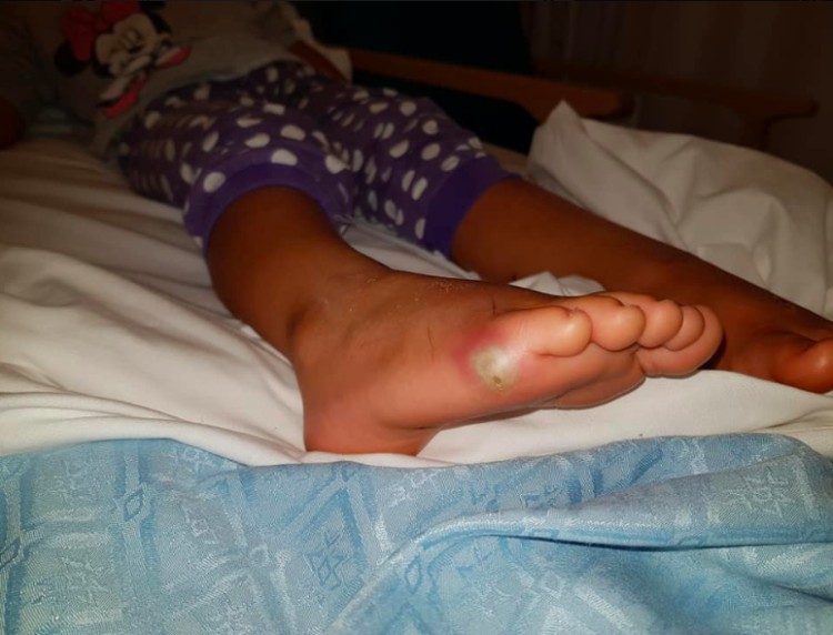 Image of little girl's foot with sepsis infection