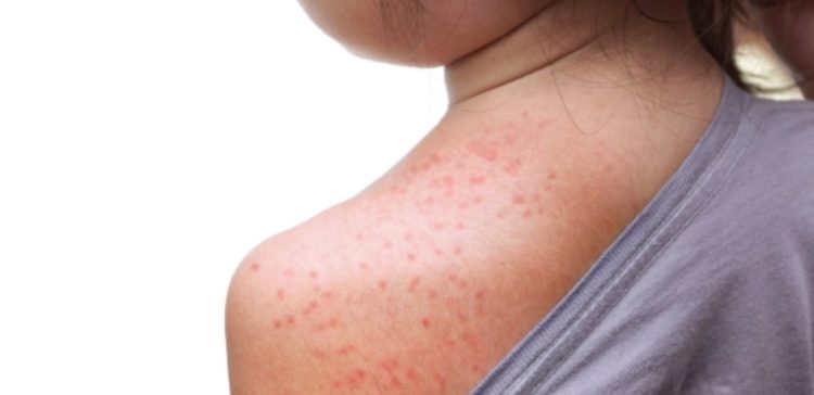measles on shoulder