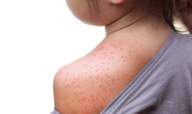 measles on shoulder