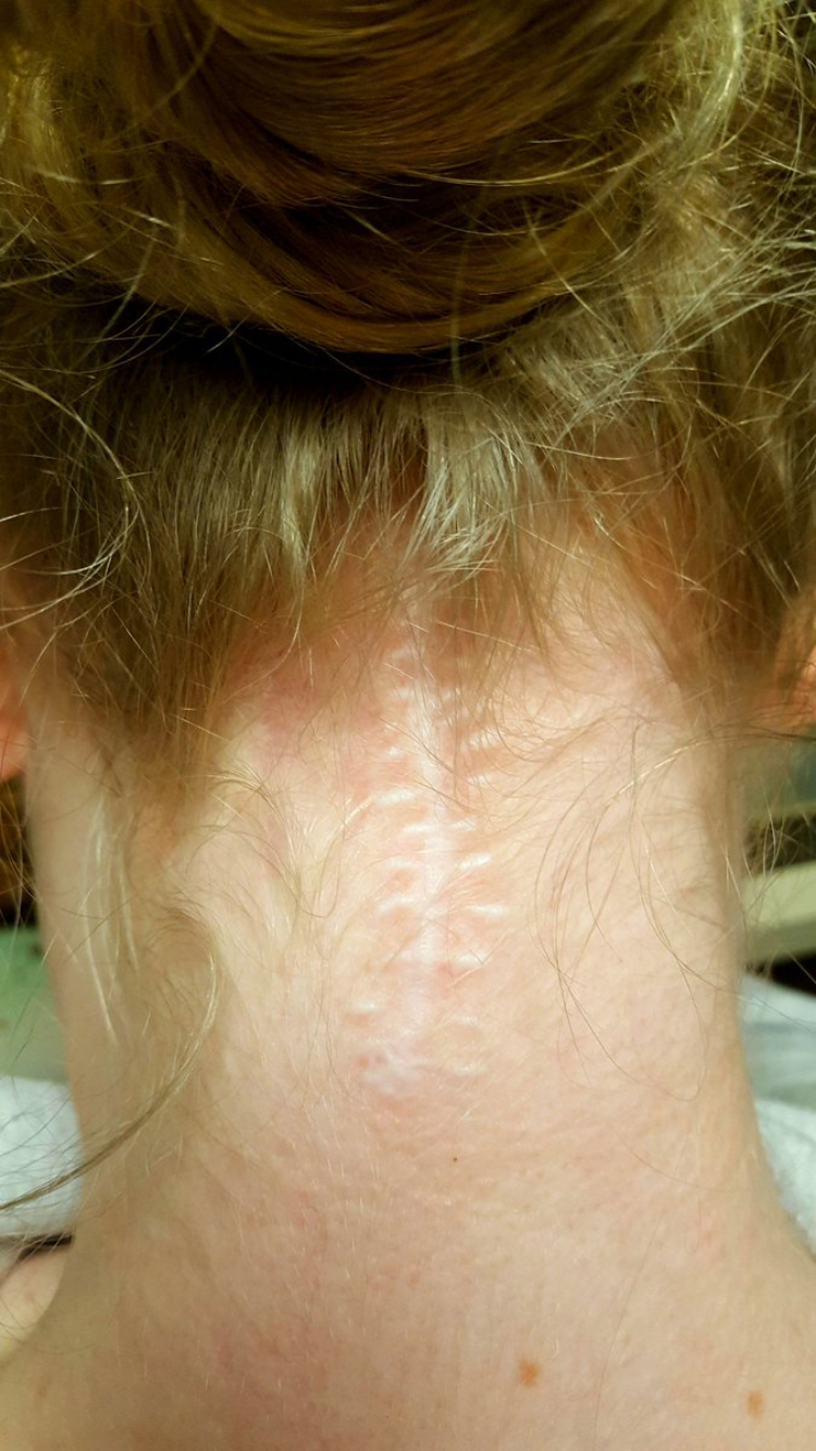 Image of girl's scar