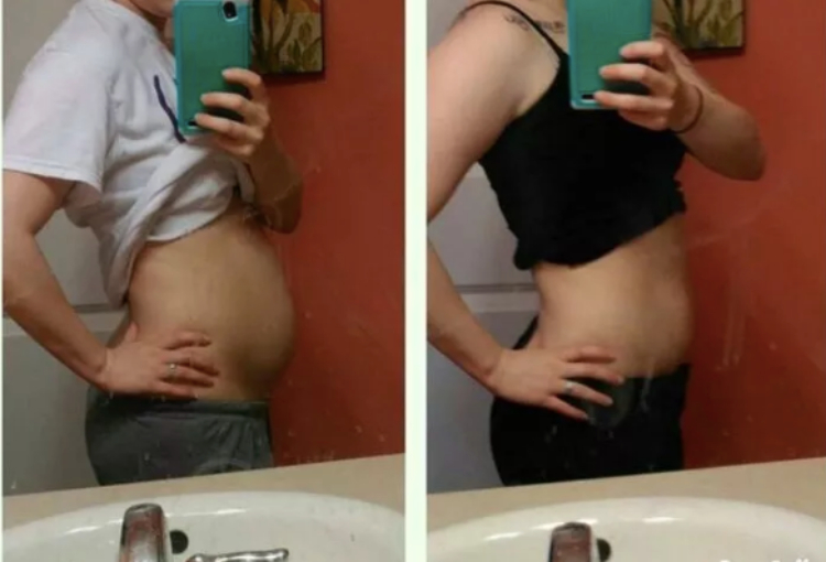 Image of before and after endo belly
