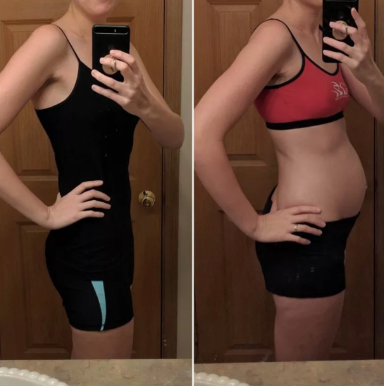 Image of before and after endo belly
