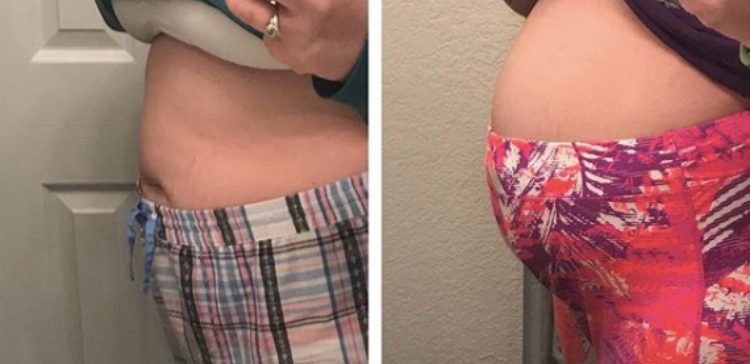 Split image of before and after endo belly