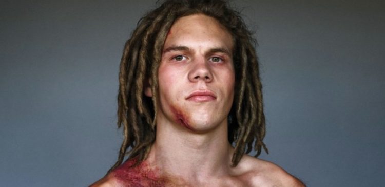 Image of car crash survivor with reenacted injuries